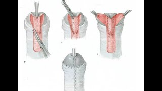 Mathieu Hypospadias repair with dartos flap by Dr  Ramesh Babu
