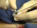 Re-Adjustable sling for Female Stress Urinary Incontinence - TRT Remeex