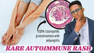 Eosinophils And Lung Disease Lets Talk Egpa, An Eosinophilic Vasculitis.