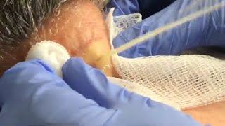 Large Cyst Squirts and Oozes from Patient's Neck