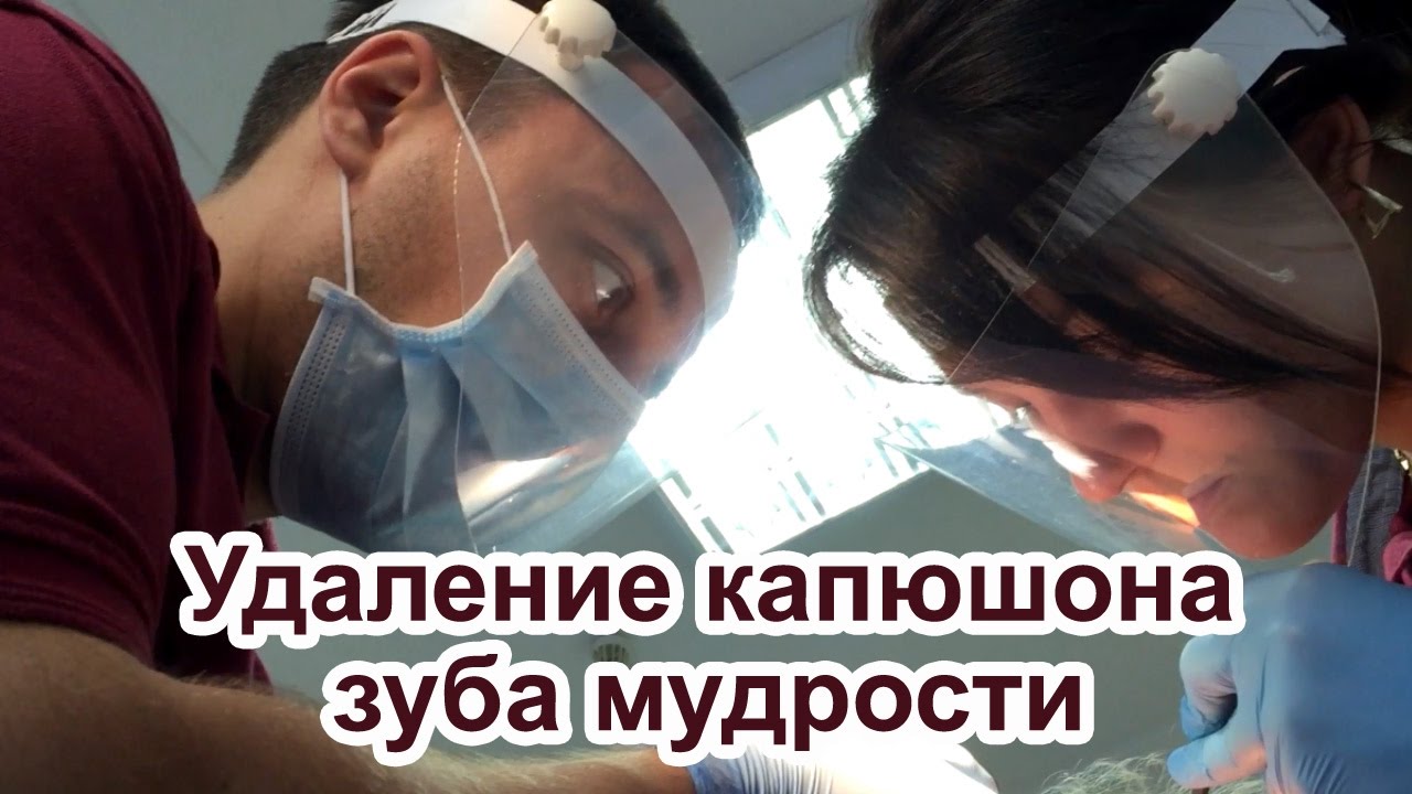 Удаление капюшона зуба мудрости будет болеть Удаление капюшона зуба мудрости будет болеть