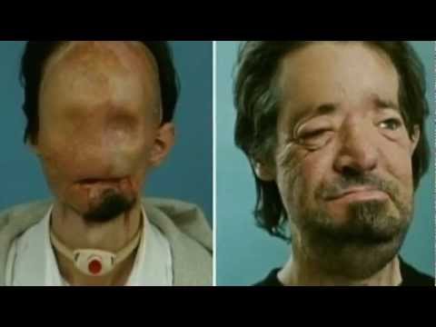 Face transplant for 'zombie' victim? First comes simple survival ...