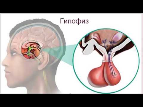 Эндо-супраселлярная аденома гипофиза Эндо-супраселлярная аденома гипофиза