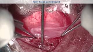 Video To Illustrate Eye Socket Reconstruction Deepening Of The Inferior Fornix