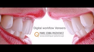 E.Max Veneers Crowns and Direct Composite Carestream CS3600 Intraoral Scan