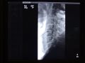2.DISCOLISIS CERVICAL EN 2 ESPACIOS