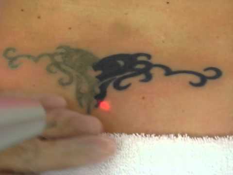 Henna Tattoo Virginia Beach on Atlantic Laser Tattoo Removal Virginia Beach Va