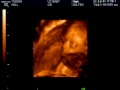 4D Ultrasound at 24 weeks Gestation: Part 1