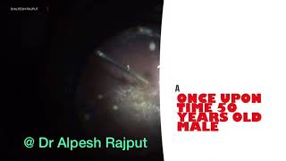 Pfcl Bubble Rotation - Vitrectomy