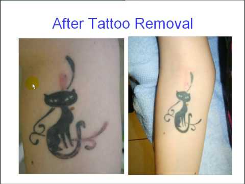 The Rejuvi tattoo removal system is a unique method of tattoo ink extraction 