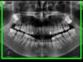 Anatomia Radiografia Panoramica dental advance clinica estetica aimone diego odontologo implantes