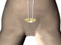 Re-Adjustable sling for Female Incontinence - TRT Remeex
