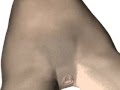 Re-Adjustable sling for Female Incontinence - TRT Remeex