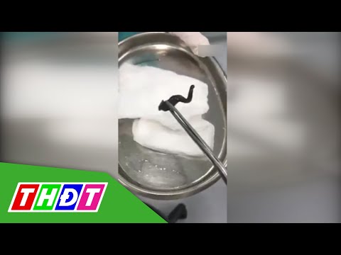Bé trai 7 tuổi chảy máu mũi dai dẳng do vắt ký sinh | THDT