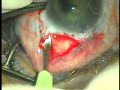 SICS Small Incision Cataract Surgery