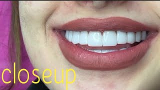 Females Teeth