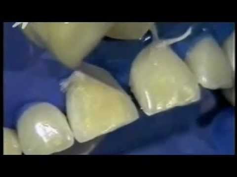 diy dental bonding teeth bonding teeth bonding procedure how to save diy dental bonding teeth bonding teeth bonding procedure how to save