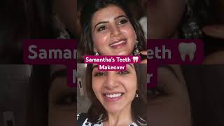 Samantha Smile Makeover