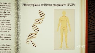This Rare Disease Turns Muscle Into Bone
