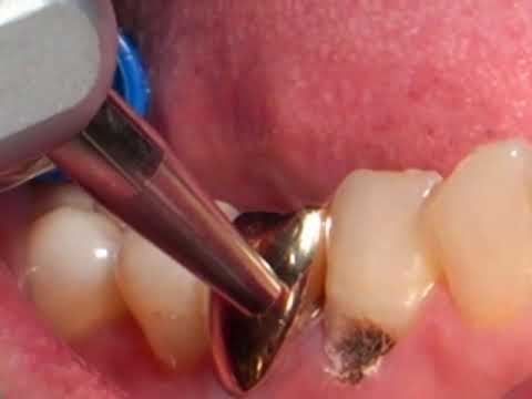 Clinical crown lengthening 1 ADR-dental