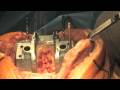 Total Knee Replacement Part 2: The Surgical Procedure