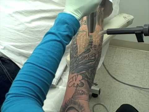 tattoo removal 1 2 sleeve blue and green ink dr tattoff laser tattoo ...