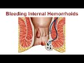 Bleeding Internal Hemorrhoids - Discover A Short Video About What They Are