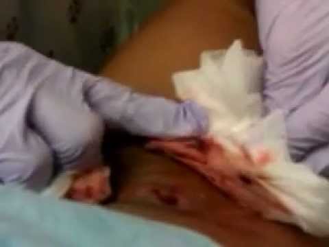 Gross - BIGGEST BURSTING BOIL!!!!