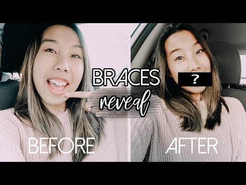 BRACES REVEAL! I FINALLY DID IT! (Braces Journey Part 1) | Emily Dao 2018
