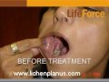 Oral Lichen Planus treated by Dr. Rajesh Shah at Life Force