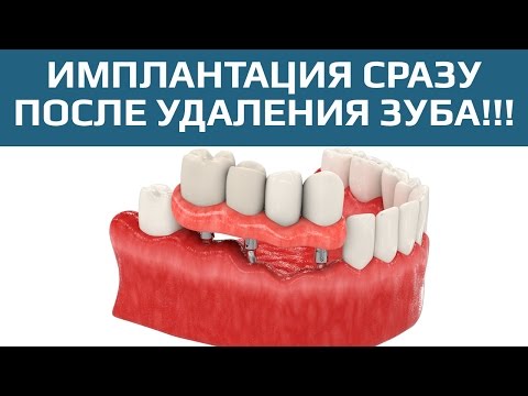 Как снять сразу в зубе Как снять сразу в зубе
