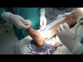 safenectomia