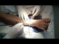 safenectomia