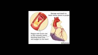 How Fat Blocked Your Arteries And Causing Heart Attack ?