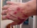 The Morgellons Lesion