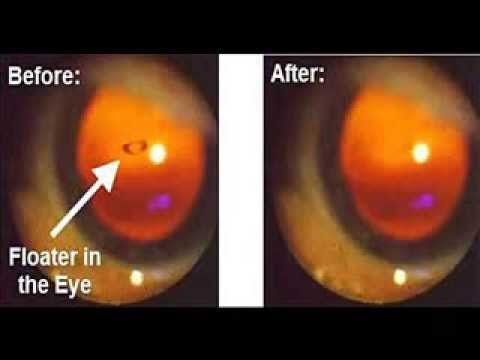 Eye Floaters Cure Treatment Naturally You Eye Floaters Cure Treatment Naturally