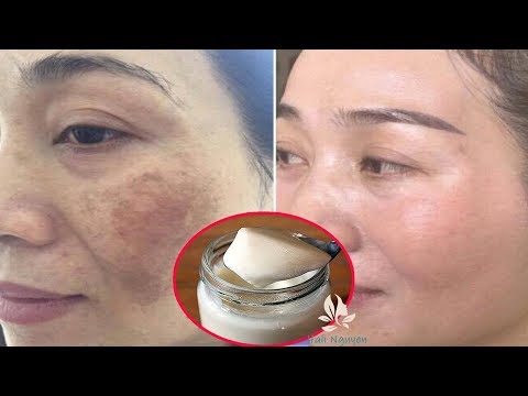 1 Thìa Sữa Chua- 7 Cách Trị Nám Tàn Nhang Đậm Đến Cỡ Nào Cũng Hết Sạch Da Láng Mịn Trẻ Ra Cả 10 Tuổi