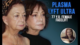 Total Facial Rejuvenation At 77 Plasma Lyft Ultra By Dr. Lacerna