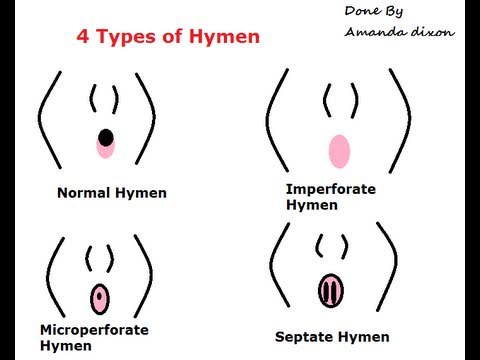 The different types of Womens Hymens-Things they didnt teach...