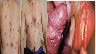 Ciri Ciri Sipilis Pada Laki Laki