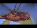 surgery