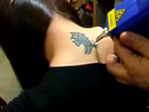 MDYouTube Nd yag Laser tattoo removal, birth mark removal treatment MPEG 1 