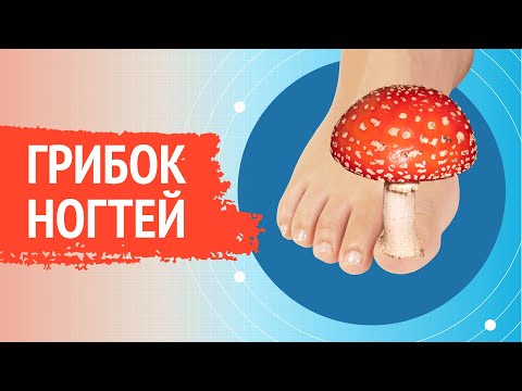 0 - Ніж лікувати запущений грибок нігтів на ногах: препарати, народні засоби, відгуки