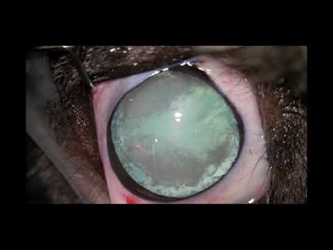 Surfy cataracte OG intracapsulaire subluxation cristallin 210315