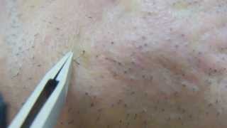 ... COM - 角栓とり-埋没毛の開放 -acne spots zits keratotic-plug
