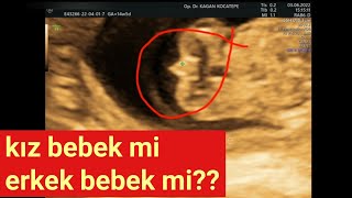 Kız bebek ultrasonda nasıl gözükür ve neden bazen erkek gibi görünür? 15. gebelik haftasındaki fetus