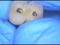 4. Avoiding Needless Dental Implant Bridge Remakes - loose abutment screws with difficult access