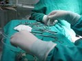 safenectomia