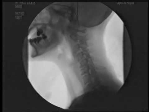 Modified Barium Swallow - Nov 2007 - YouTube