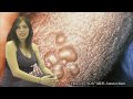STDs, Sexually Transmitted Disease 2, Herpes Symptoms & Treatments Hot Facts Girl Kayleigh